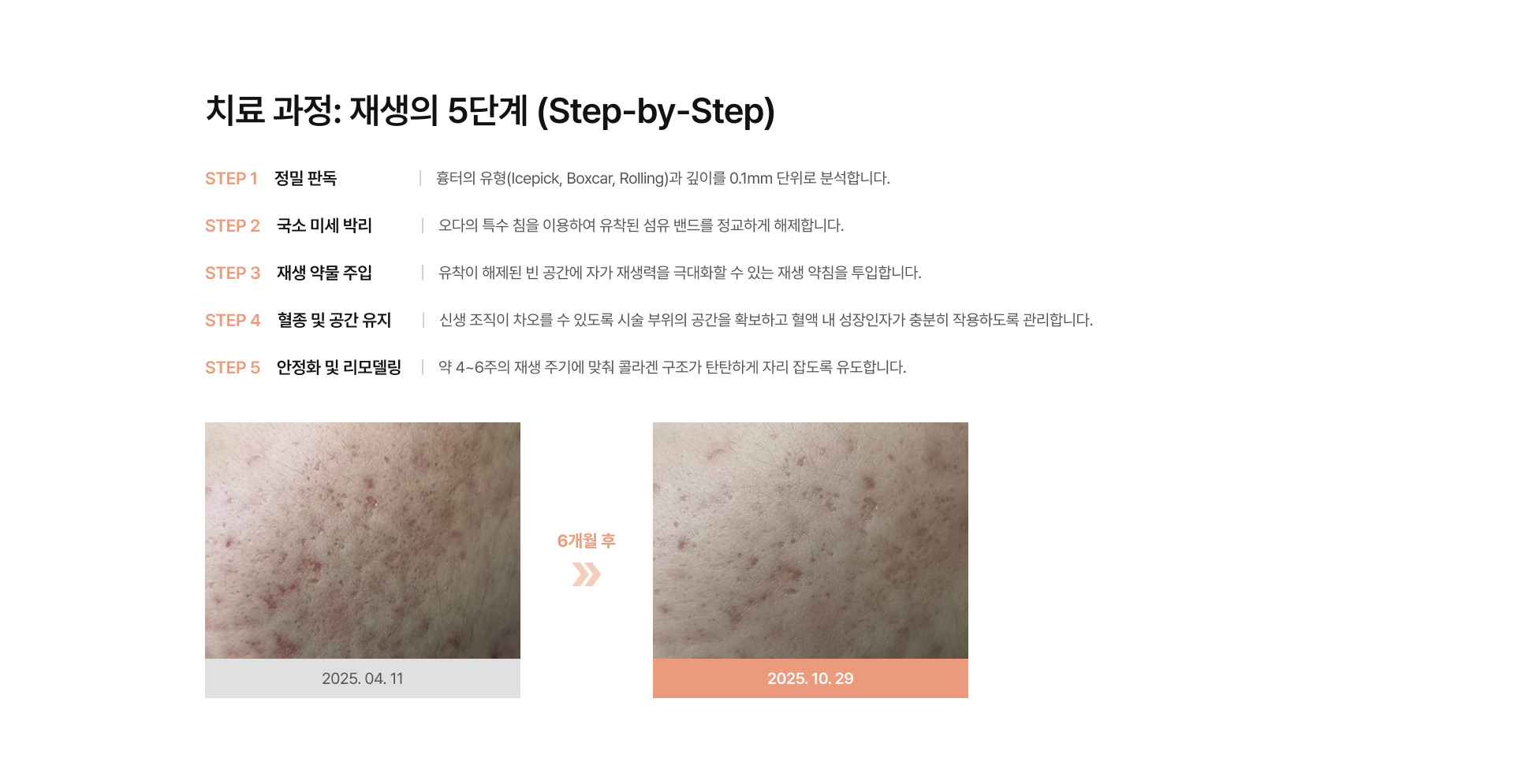 새살침 프로그램 04