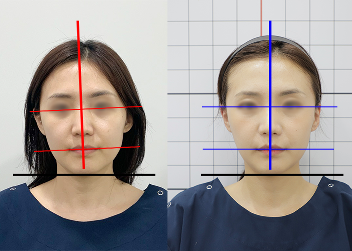 20대, 안면비대칭, 안면비대칭 교정