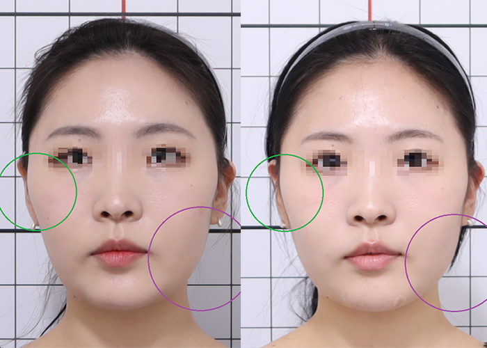 20대, 안면비대칭, 안면비대칭 교정