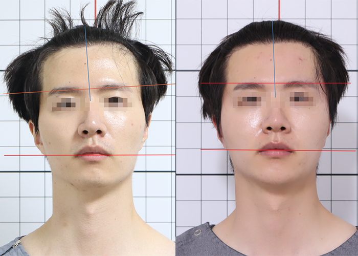 20대, 안면비대칭, 안면비대칭 교정