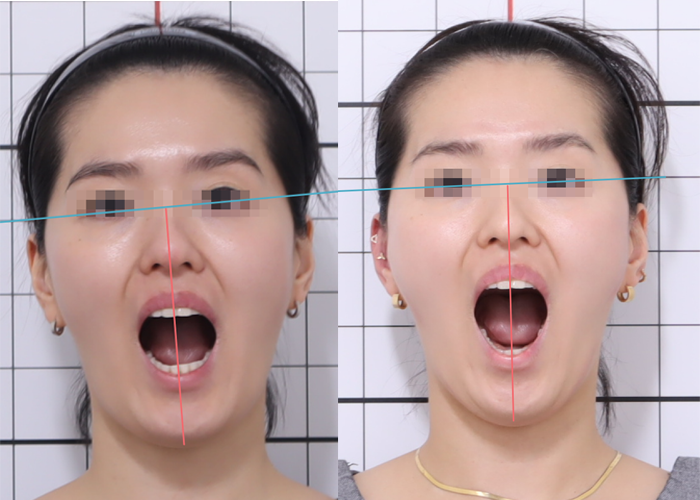 20대, 안면비대칭, 안면비대칭 교정