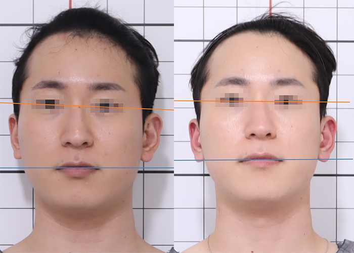 20대, 안면비대칭, 안면비대칭 교정