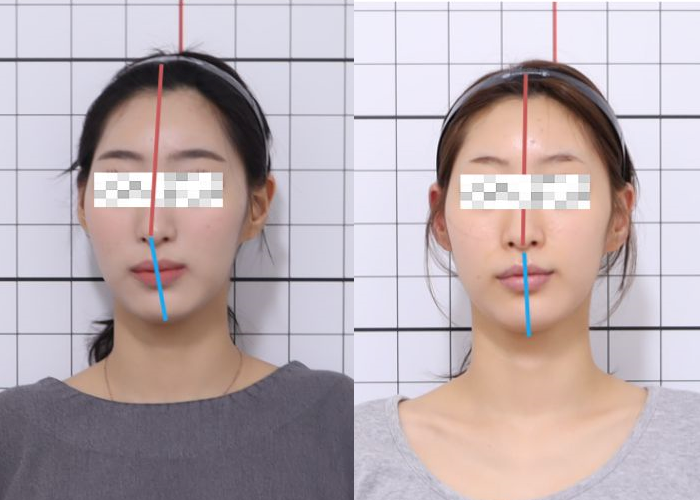 20대, 안면비대칭, 안면비대칭 교정